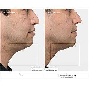 Therabody TheraFace PRO Ultimate Facial Health Device - juodas - su laidžiu geliu